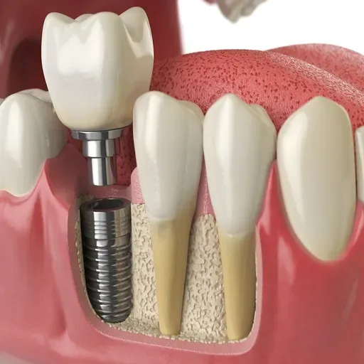 Dental Implants Maintenance: How to Care for Long-Term Durability