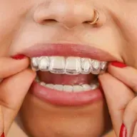 Teeth Aligners and Oral Health Benefits