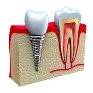 5 dúvidas sobre Implantes dentários