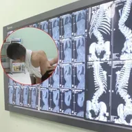 Dấu hiệu nhận biết sớm cong vẹo cột sống ở trẻ