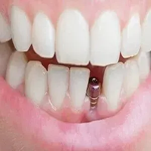 Dental Implants: The Future of Permanent Tooth Solutions