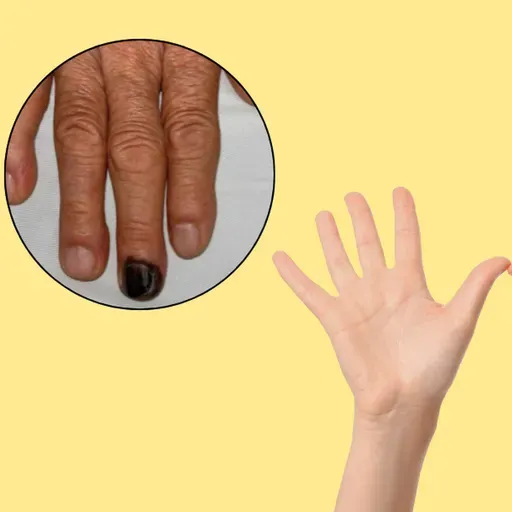 Móng tay màu đen như tụ máu là dấu hiệu của bệnh gì, có nguy hiểm?