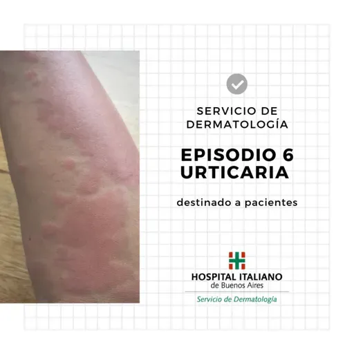 Urticaria destinado a pacientes