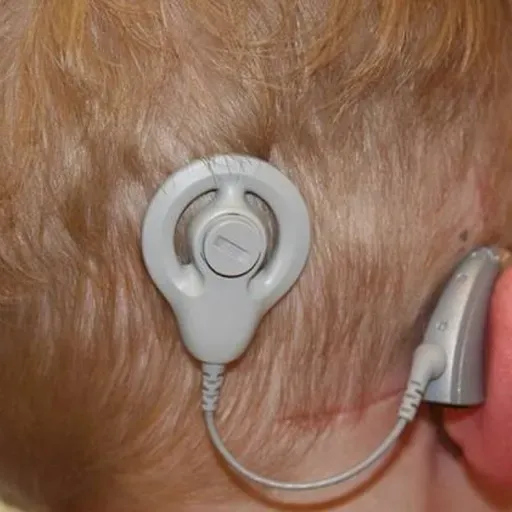 REACCIÓN EN CADENA T08C008 Implantes cocleares y neumología en Reacción en Cadena (25/11/2025)