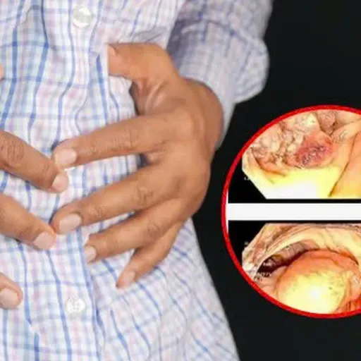5 người trong gia đình cùng mắc ung thư đại tràng, bác sĩ khuyến cáo điều gì?