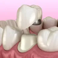 Dental Crown Problems: Causes, Fixes, and Prevention