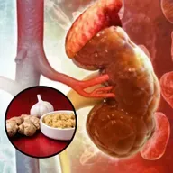 Tỏi và gừng có làm tan sỏi thận sau 21 ngày như thông tin lan truyền?