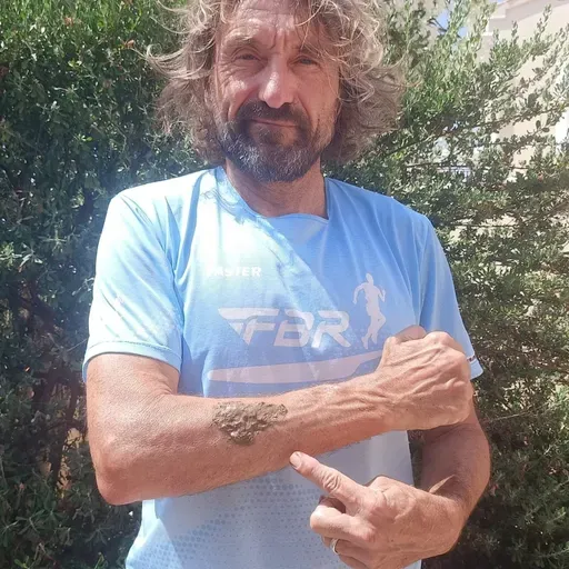 Consejos para Runners - Qué hacer si te pica una avispa mientras entrenas (04/07/2025)