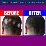 Reversing Alopecia: The Impact Of 3 Trace Minerals