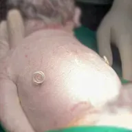 Em bé được cứu chữa từ trong bụng mẹ, chào đời với 'đôi cánh tí hon'