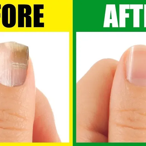 Find Out The Deeper Causes of Brittle Nails