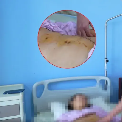 Ca mổ hy hữu, lấy thận ra khỏi cơ thể người phụ nữ trẻ để 'sửa chữa' rồi ghép lại