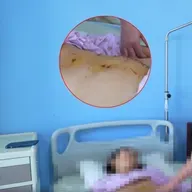 Ca mổ hy hữu, lấy thận ra khỏi cơ thể người phụ nữ trẻ để 'sửa chữa' rồi ghép lại