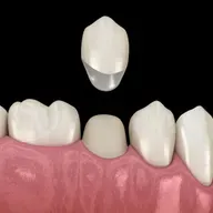 Dental Crown Solutions for Damaged Teeth