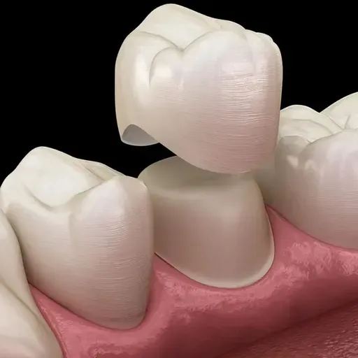 Dental Crown Advances in Modern Restorative Dentistry