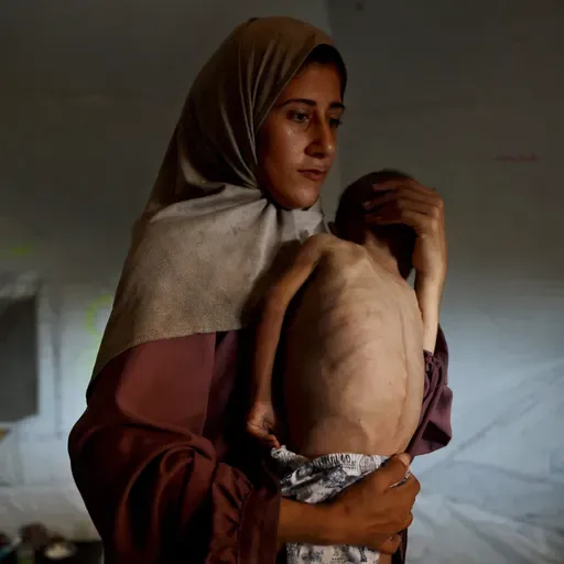 Extreme Hunger In Gaza. France To Recognize Palestinian State