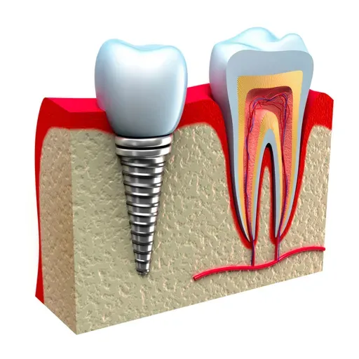 5 dúvidas sobre Implantes dentários