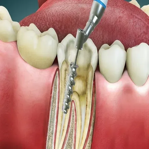 Root Canal: Save Your Smile