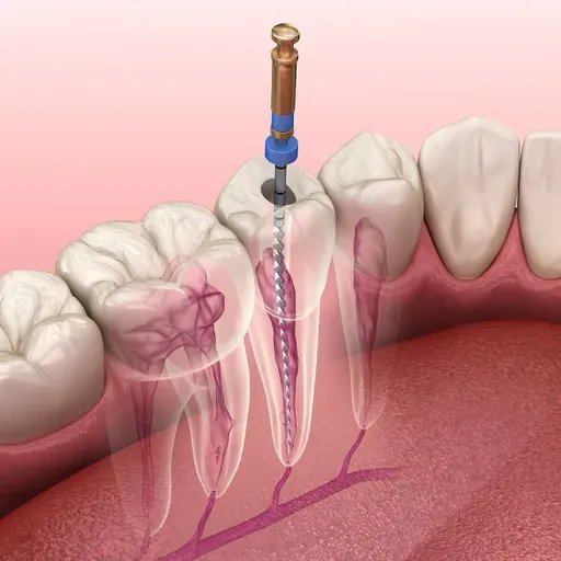 Root Canal Explained by Dental Professionals