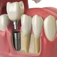 Dental Implants Maintenance: How to Care for Long-Term Durability