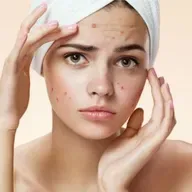 ¿Cómo puedes curar el acné? A2110-1-1-3