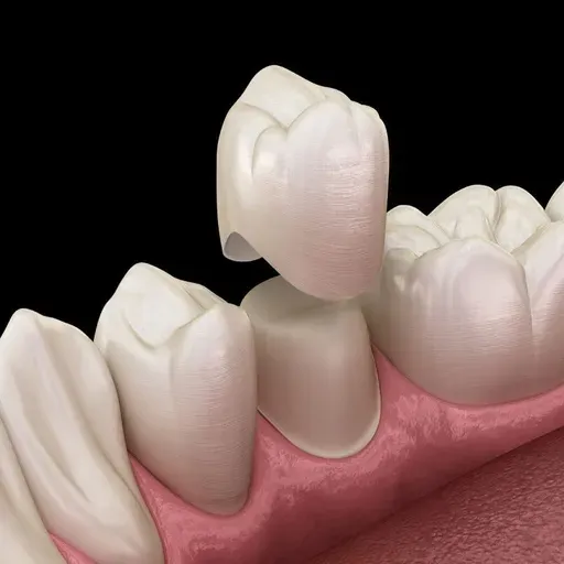 Dental Crown: Expert Tips for Maintaining Your New Crown