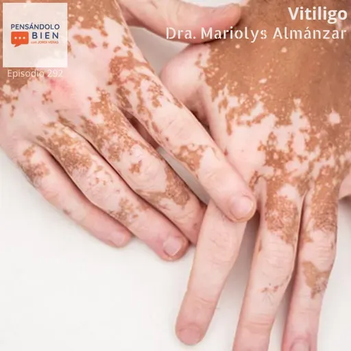 Vitiligo