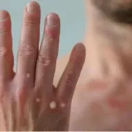 Quatro emergências em saúde ameaçam as Américas, alerta OMS