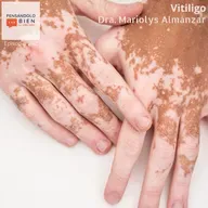 Vitiligo