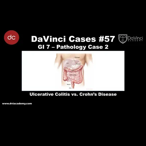 Ulcerative Colitis vs Crohn’s Disease [#DaVinciCases GI 7 - Pathology Case 2]