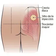 Cómo Aplicarse inyección Intramuscular Uno mismo E #39