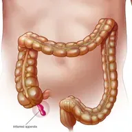 Esta Enfermedad no TIENE prevención (APENDICITIS) Ep. Extra