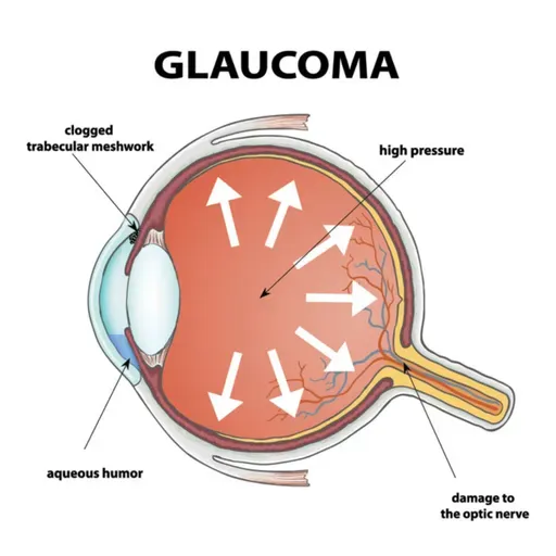 ✳️ GLAUCOMA