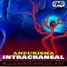 S2E29: Todo acerca del aneurisma intracraneal, cómo afecta en las relaciones sexuales 