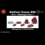 Pathogenesis of Colon Cancer [#DaVinciCases GI 6 - Pathology Case 1]
