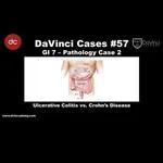 Ulcerative Colitis vs Crohn’s Disease [#DaVinciCases GI 7 - Pathology Case 2]